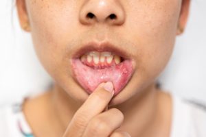 candidiase oral